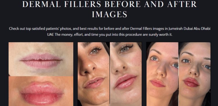 Luxury vs. Budget Fillers in Dubai: Are Expensive Fillers Worth It?