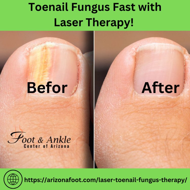 What Are the Signs and Symptoms of Toenail Fungus?